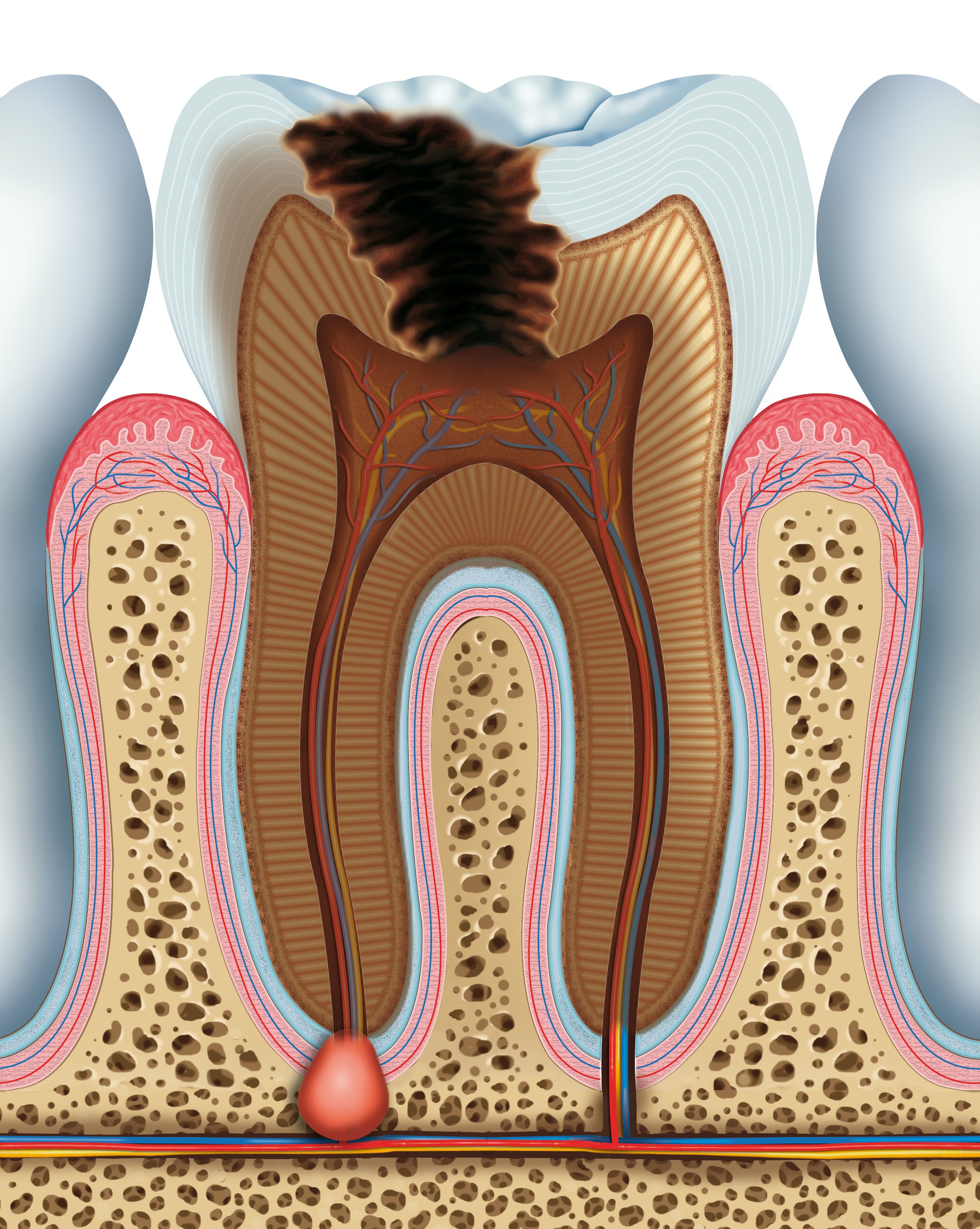 
        Kanal Tedavisi (Endodonti) Nedir ?