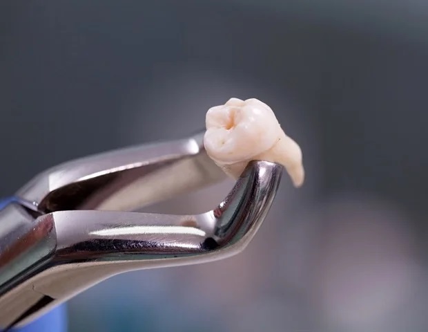
        Tooth Extraction