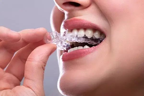 Clear Aligners