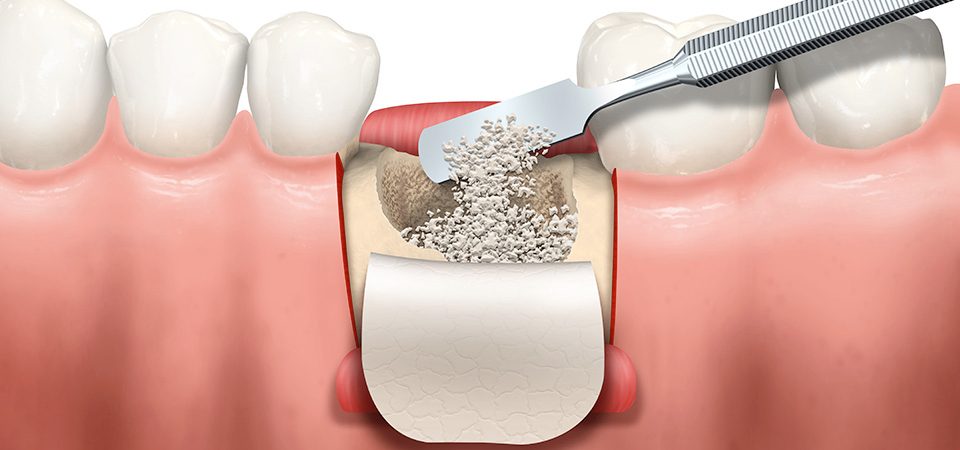 
        Rejeneratif periodontal tedaviler (Kemik grefti uygulamaları)